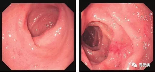 萎縮性胃炎不可怕，只要真正了解它