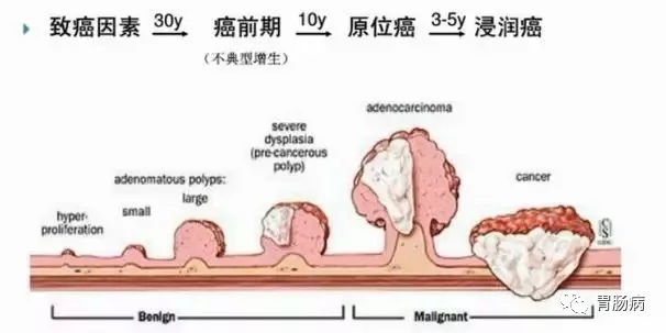 體檢查出腸息肉一定要切除！ 95%腸癌由它演變而來