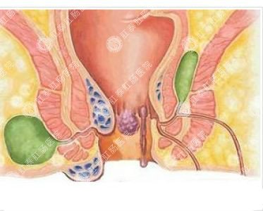 南寧哪個(gè)醫(yī)院可以做肛周膿腫？